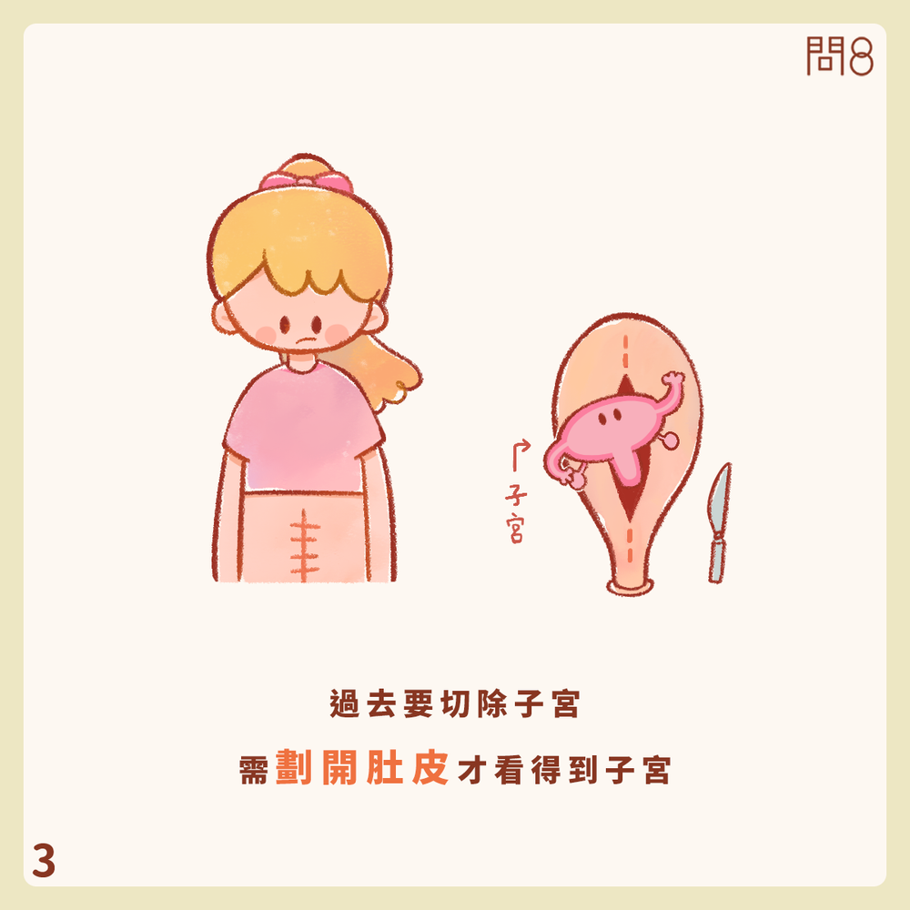 什麼是自然孔內視鏡手術(NOTES)?
