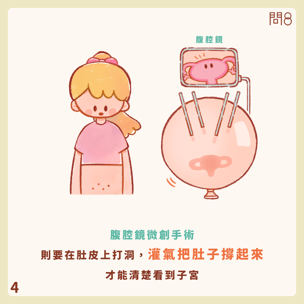 什麼是自然孔內視鏡手術(NOTES)?