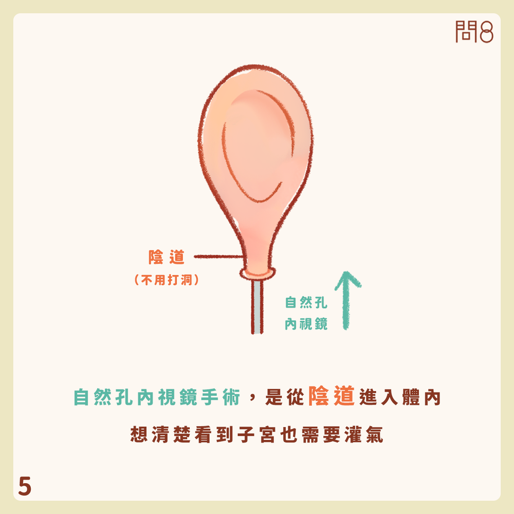 什麼是自然孔內視鏡手術(NOTES)?