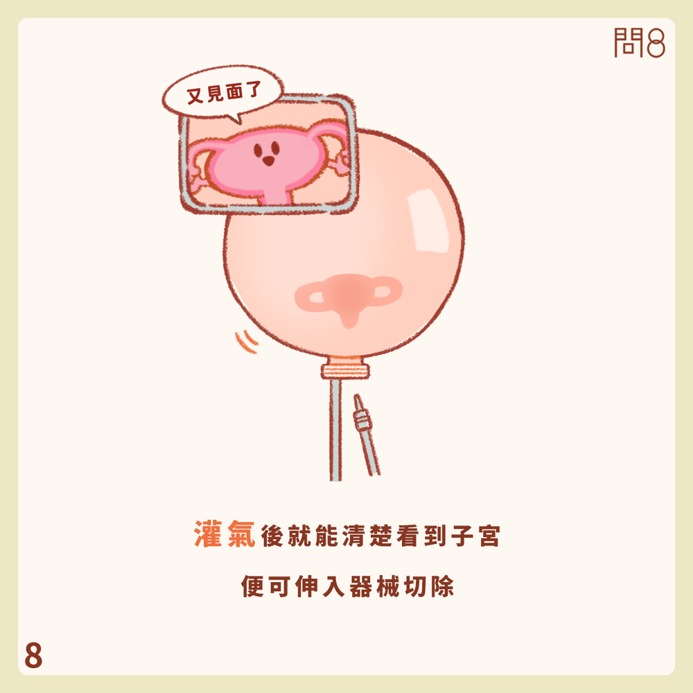 什麼是自然孔內視鏡手術(NOTES)?