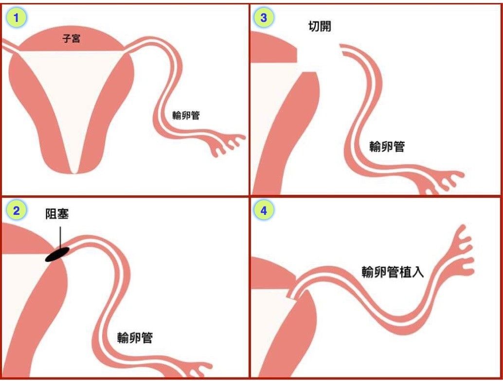 輸卵管阻塞怎麼自然懷孕?